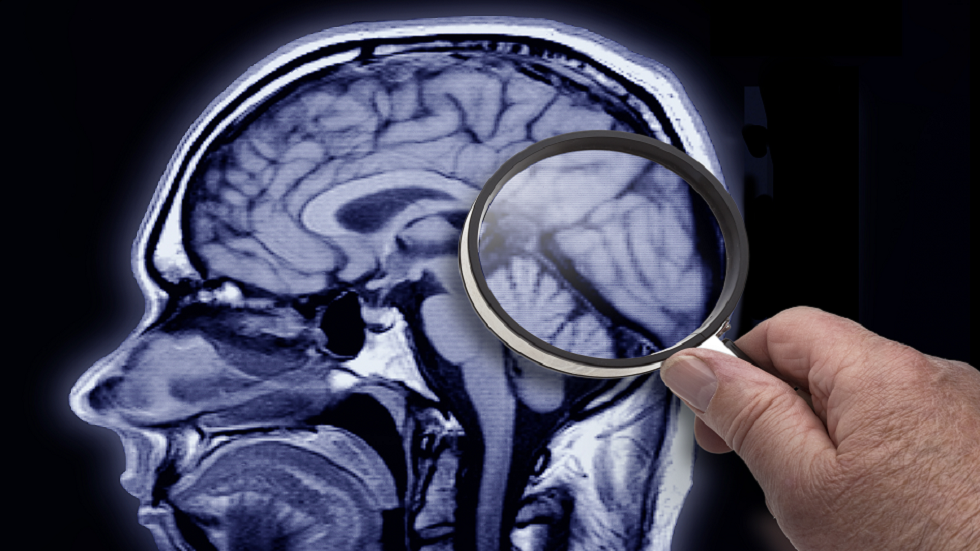 العلماء يحددون سبب تطور مرض ألزهايمر في الدماغ