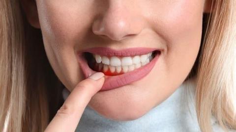 6 home remedies to get rid of bleeding gums