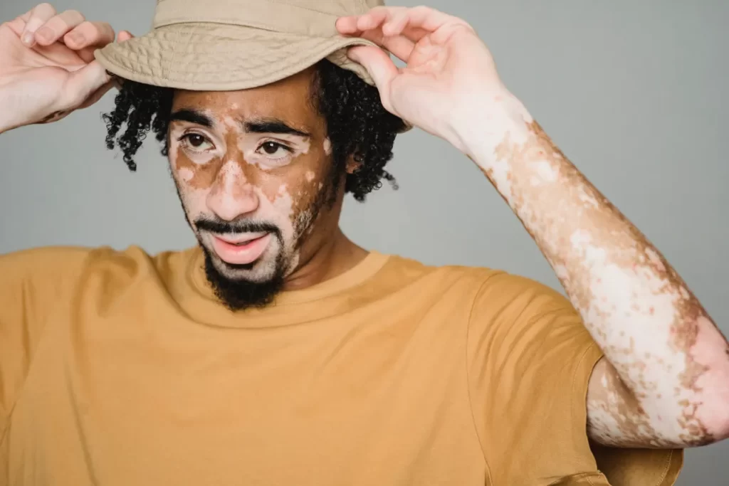 UAE first to approve RINVOQ for non-segmental vitiligo treatment RINVOQ approval non-segmental vitiligo UAE